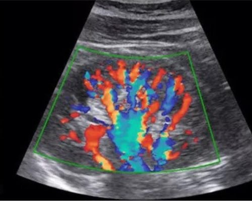 Colour Doppler Studies