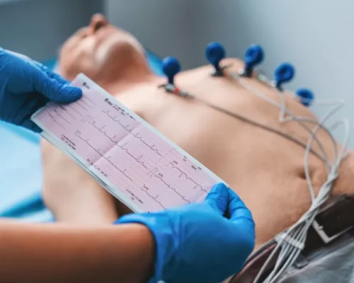 ECG (Electrocardiogram)